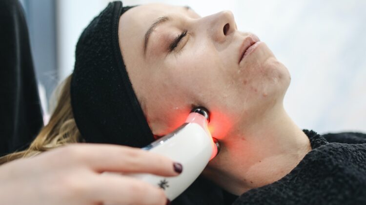 Acne Laser Treatments